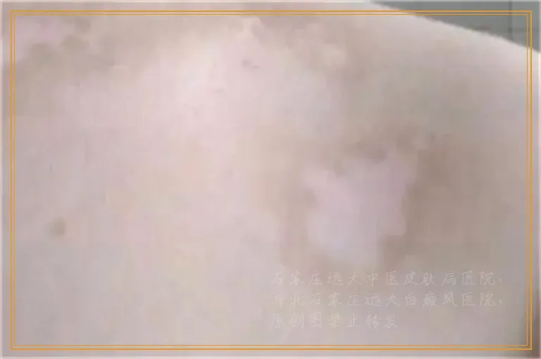 脸上多了一块白的是怎么回事