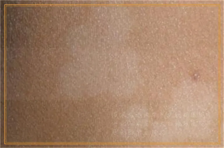 脖子上的一块皮肤变白了很光滑是什么病