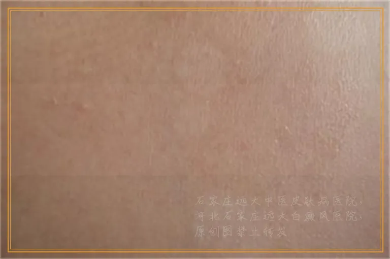 女孩额头长白斑治疗大概需要多少钱