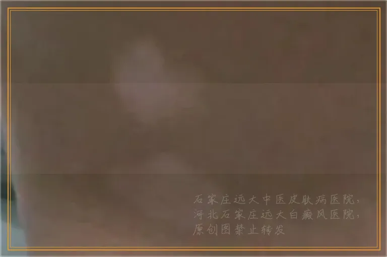 哺乳期胸上长白斑是怎么回事