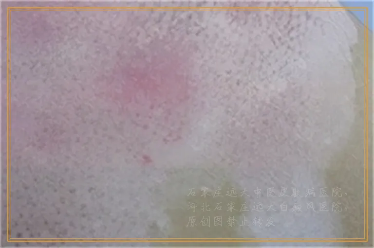 女生胸下面好多白色点点是什么