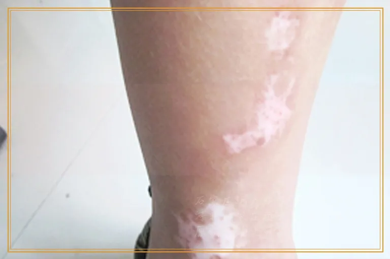 腰部和腿部长白斑白点怎么办