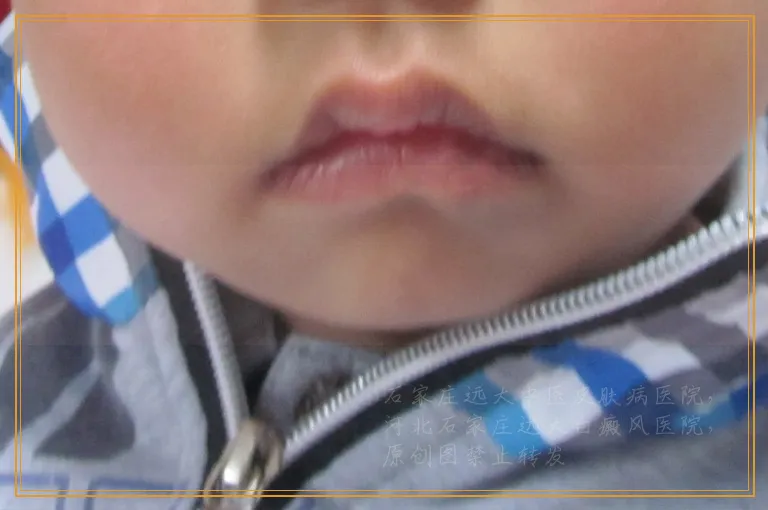 白癜风初期白点图片