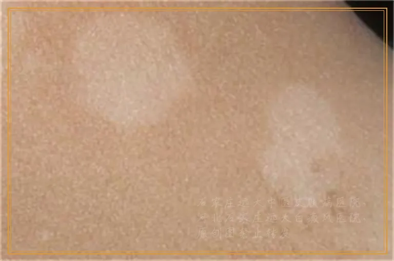 手背上有浅色白斑是什么病