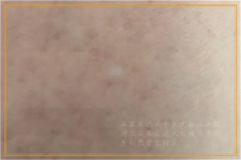 婴儿得白癜风是什么样子的图片