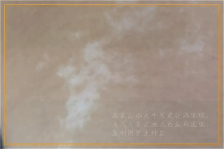 婴儿身上正常白斑图片长什么样
