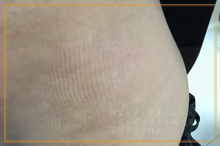 男性生殖器上长白斑变大去医院挂什么科