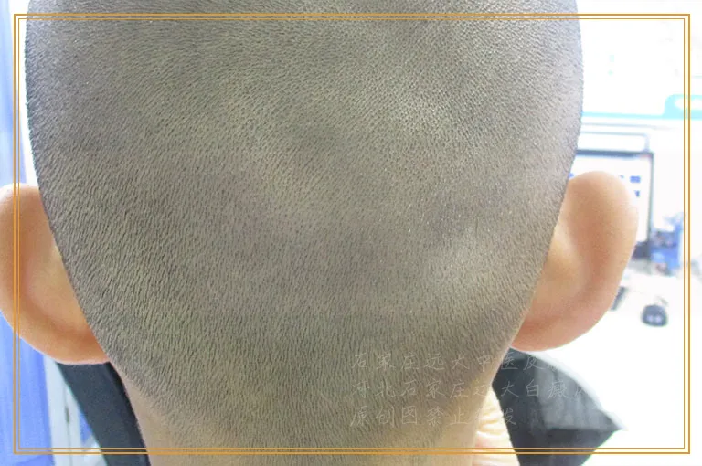 腰部突然白一片是白癜风吗