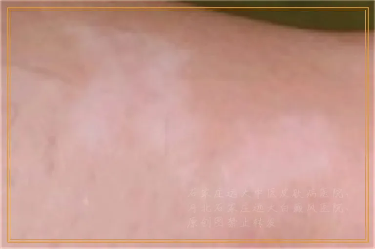 身上有白点是什么病