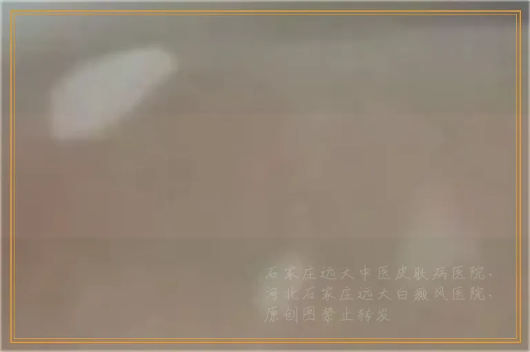 小孩背上皮肤突然白一块怎么回事