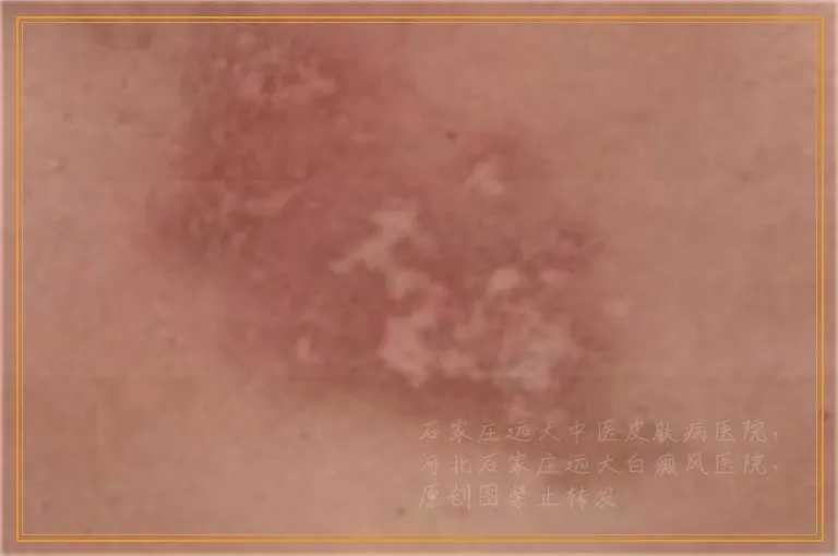 腿上皮肤白了一块是白癜风吗