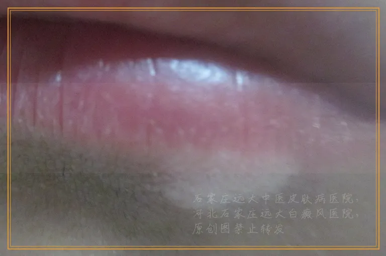 胳膊上长白斑是怎么回事