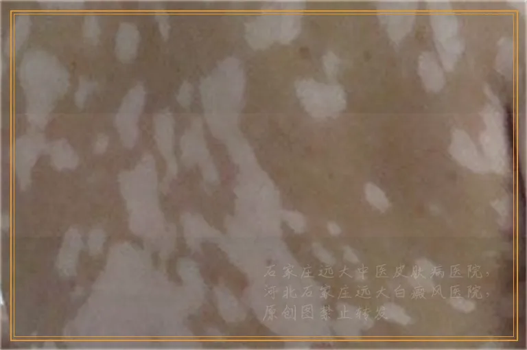 脸上有白色的小块是什么病为什么长白块