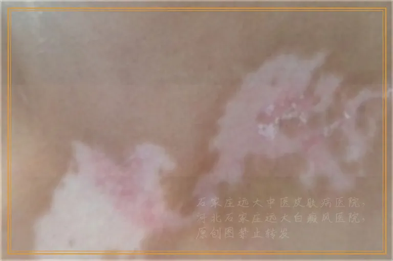 上嘴唇正中间白了一块是白癜风吗