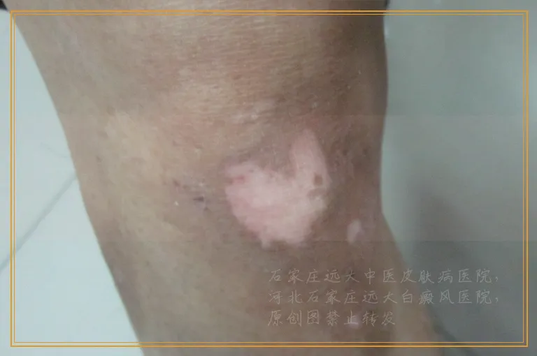 冬天脸上长白斑是怎么回事