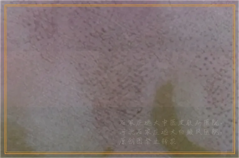 脚指头白了一大块是白癜风吗