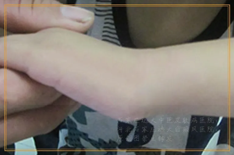 身上长了几个不规则的白点是什么病