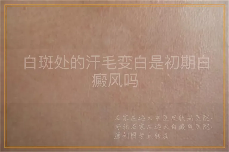 白斑处的汗毛变白是初期白癜风吗