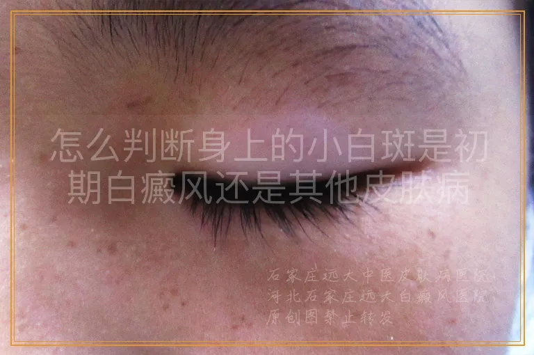 怎么判断身上的小白斑是初期白癜风还是其他皮肤病