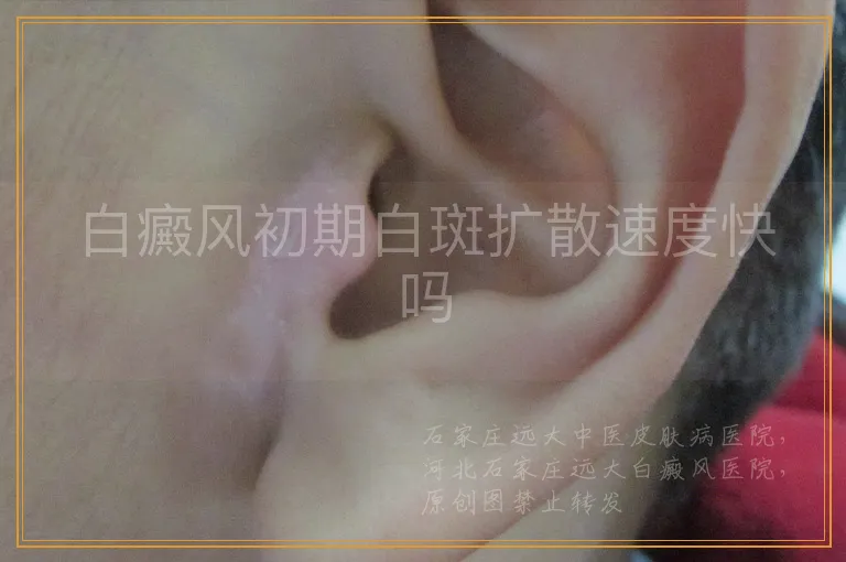 白癜风初期白斑扩散速度快吗