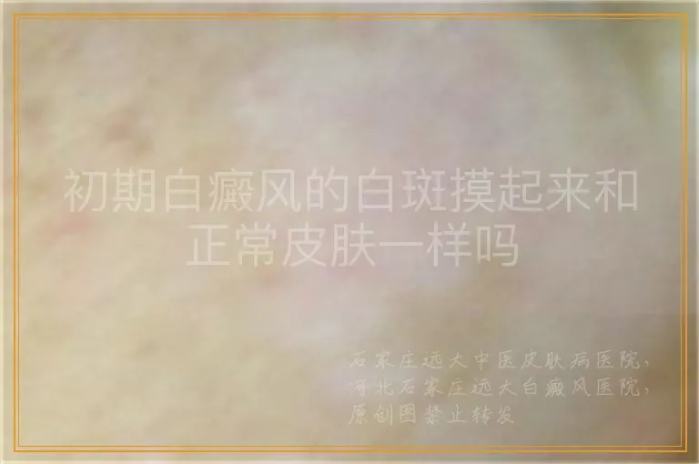 初期白癜风的白斑摸起来和正常皮肤一样吗