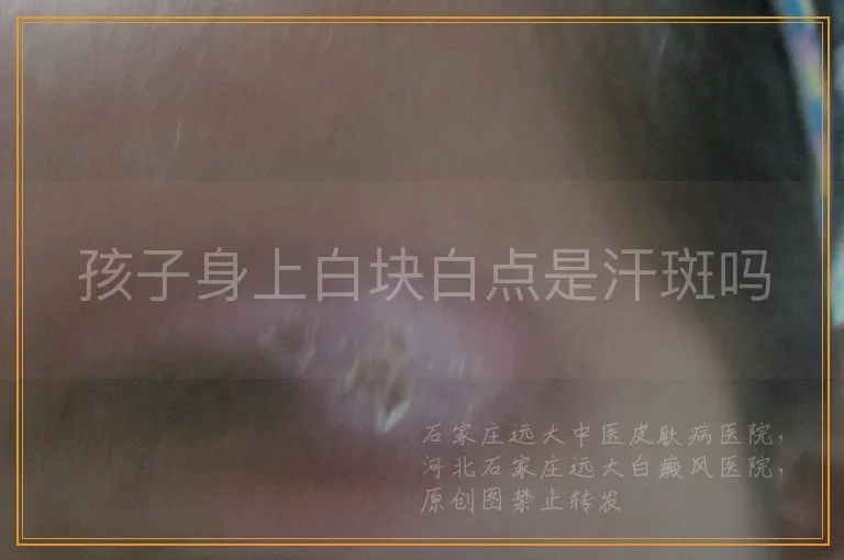 孩子身上白块白点是汗斑吗