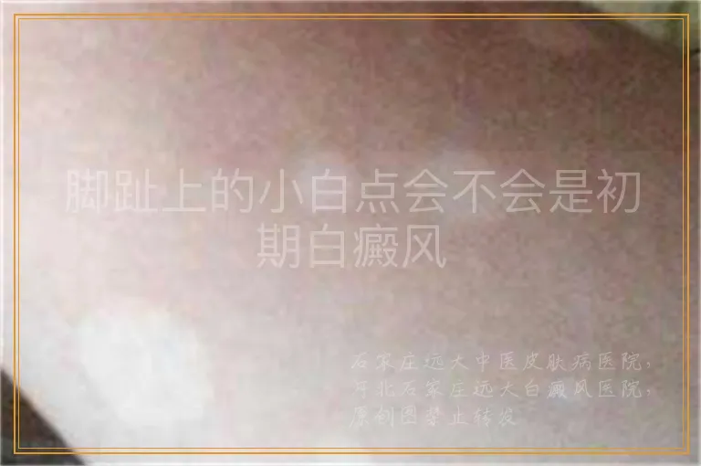 脚趾上的小白点会不会是初期白癜风