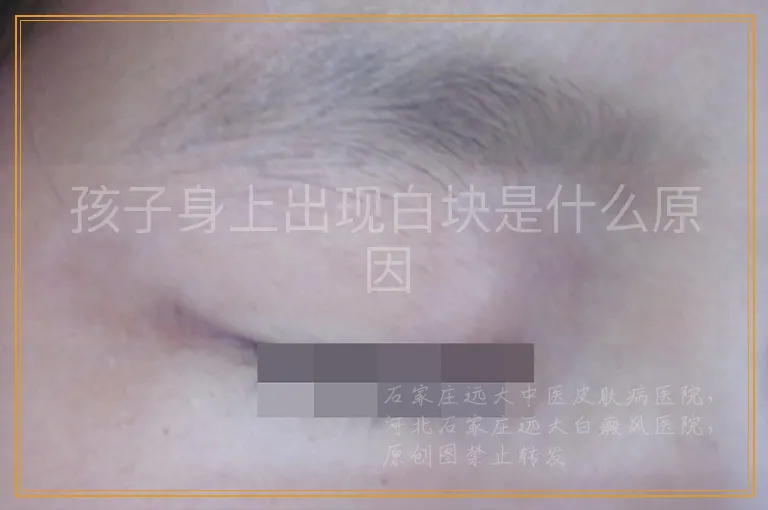 孩子身上出现白块是什么原因