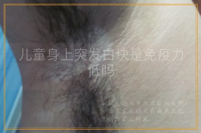 儿童身上突发白块是免疫力低吗