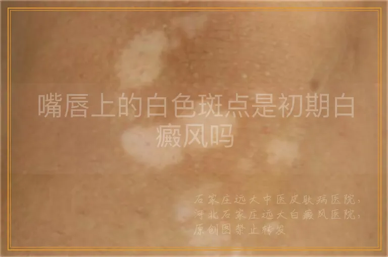 嘴唇上的白色斑点是初期白癜风吗