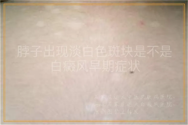 脖子出现淡白色斑块是不是白癜风早期症状