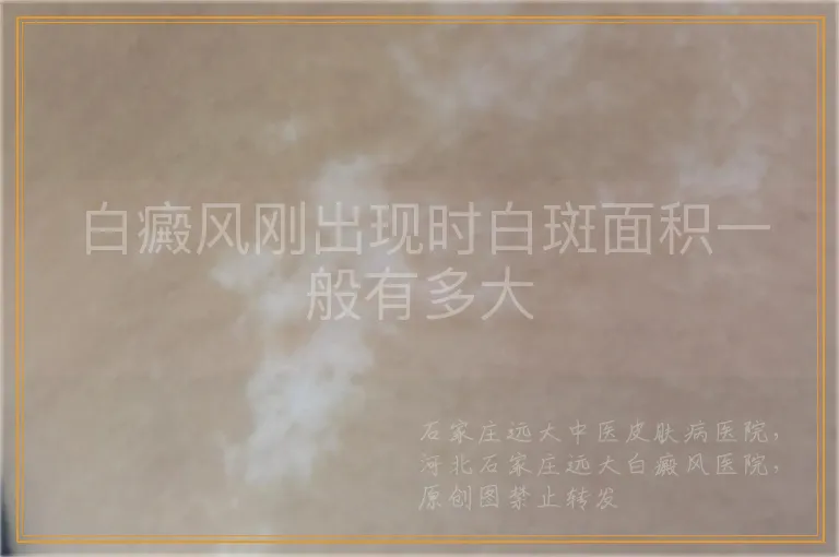 白癜风刚出现时白斑面积一般有多大