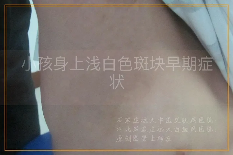 小孩身上浅白色斑块早期症状
