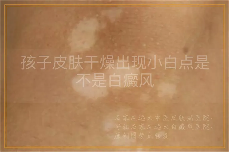 孩子皮肤干燥出现小白点是不是白癜风
