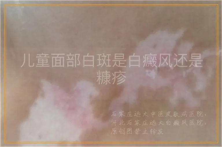 儿童面部白斑是白癜风还是糠疹