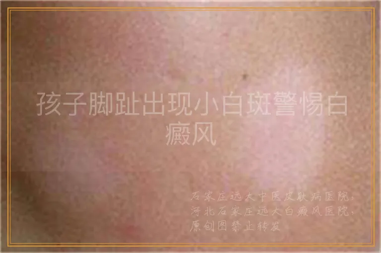 孩子脚趾出现小白斑警惕白癜风