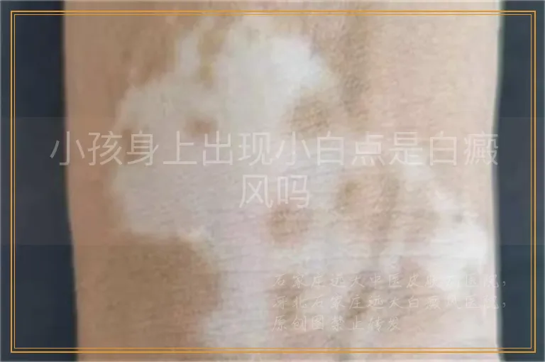 小孩身上出现小白点是白癜风吗