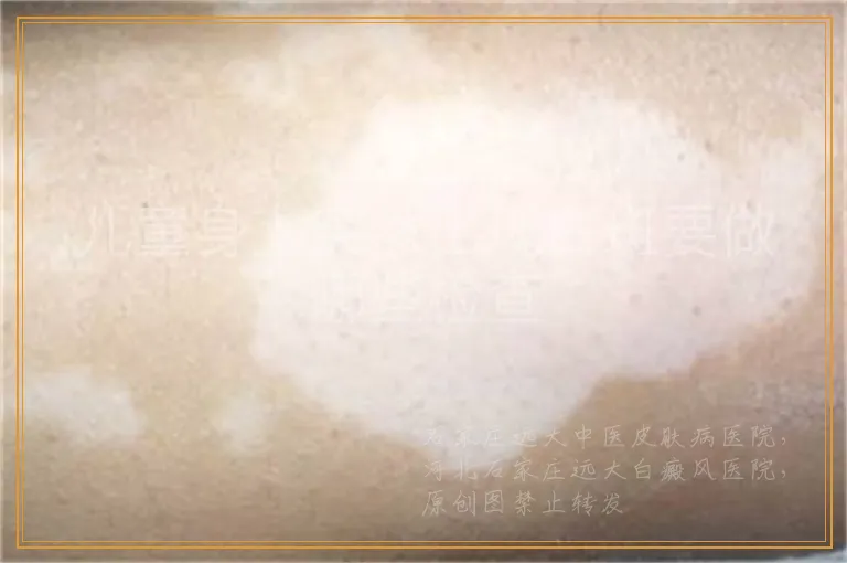 儿童身上突然出现白斑要做哪些检查
