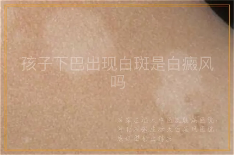 孩子下巴出现白斑是白癜风吗