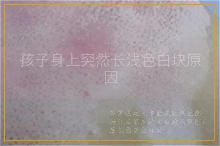 孩子身上突然长浅色白块原因