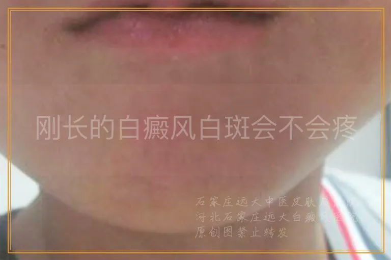 刚长的白癜风白斑会不会疼