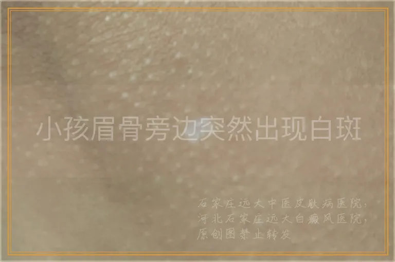 小孩眉骨旁边突然出现白斑