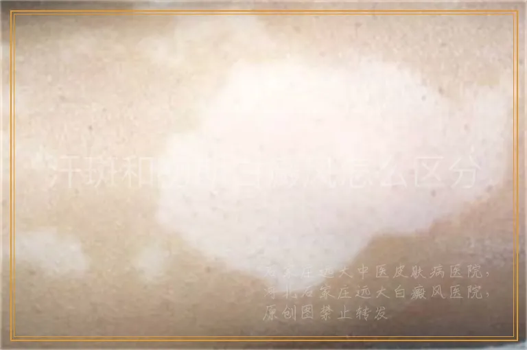 汗斑和初期白癜风怎么区分