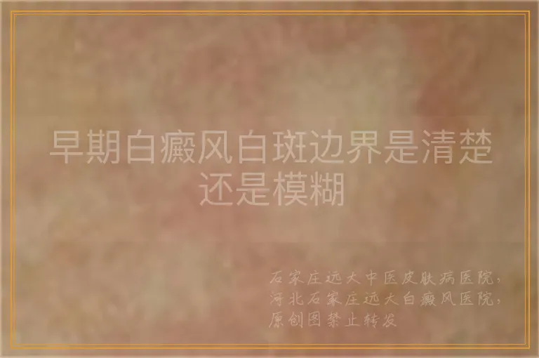 早期白癜风白斑边界是清楚还是模糊