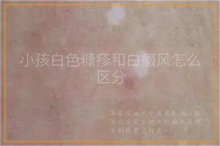 小孩白色糠疹和白癜风怎么区分