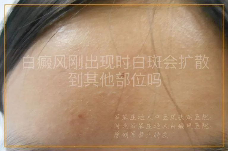 白癜风刚出现时白斑会扩散到其他部位吗
