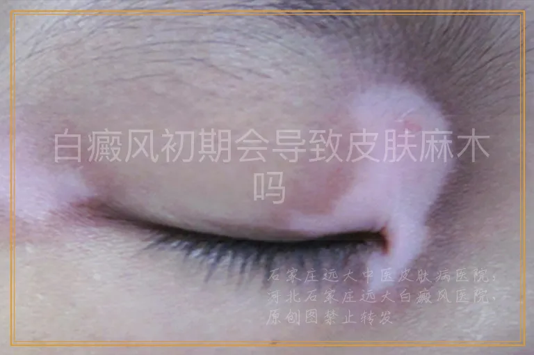白癜风初期会导致皮肤麻木吗