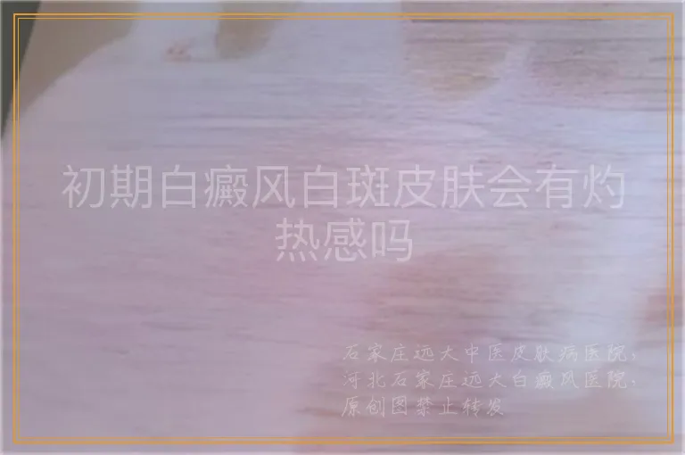 初期白癜风白斑皮肤会有灼热感吗