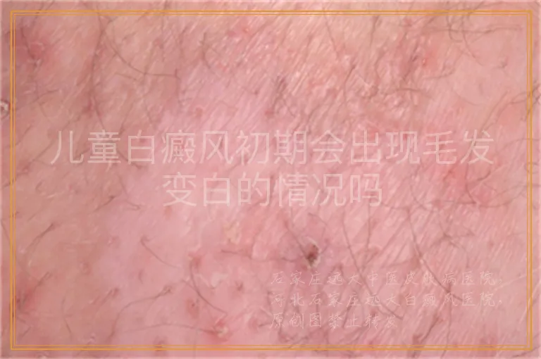 儿童白癜风初期会出现毛发变白的情况吗