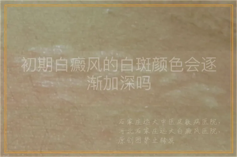 初期白癜风的白斑颜色会逐渐加深吗